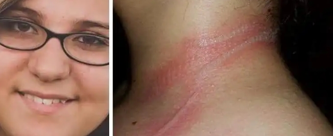 13-jähriges Mädchen erleidet schreckliche Verbrennungen am Hals – Benutzte ihr Handy, während dies auflud